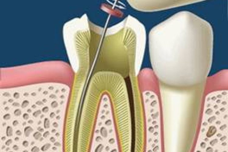 Endodoncia